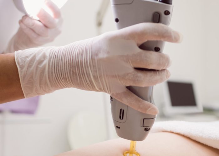 Close up of doctor performing laser hair removal on female patient skin in clinic